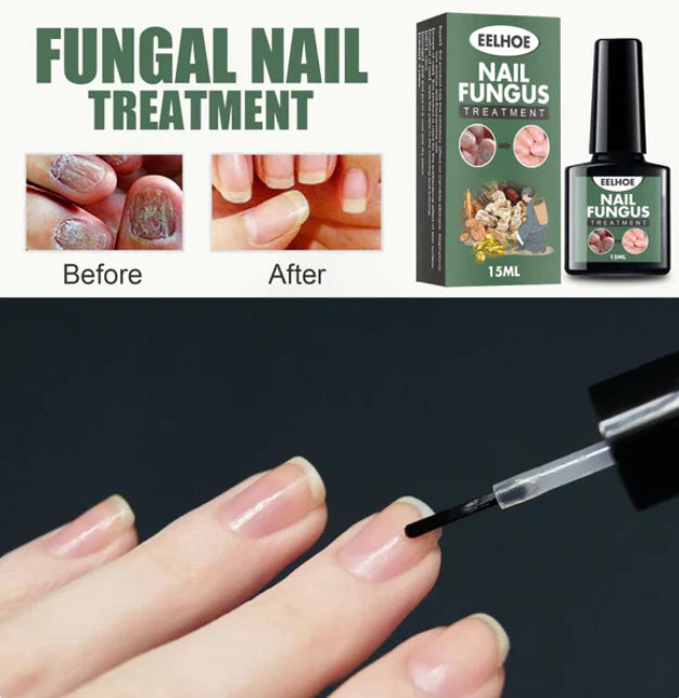 Ulje za gljivice i ispucale nokte NAIL FUNGUS