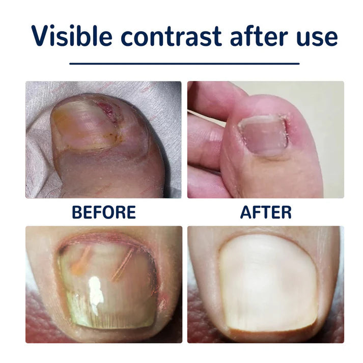 Flasteri za urasle nokte 1+1 GRATIS