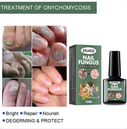 Ulje za gljivice i ispucale nokte NAIL FUNGUS